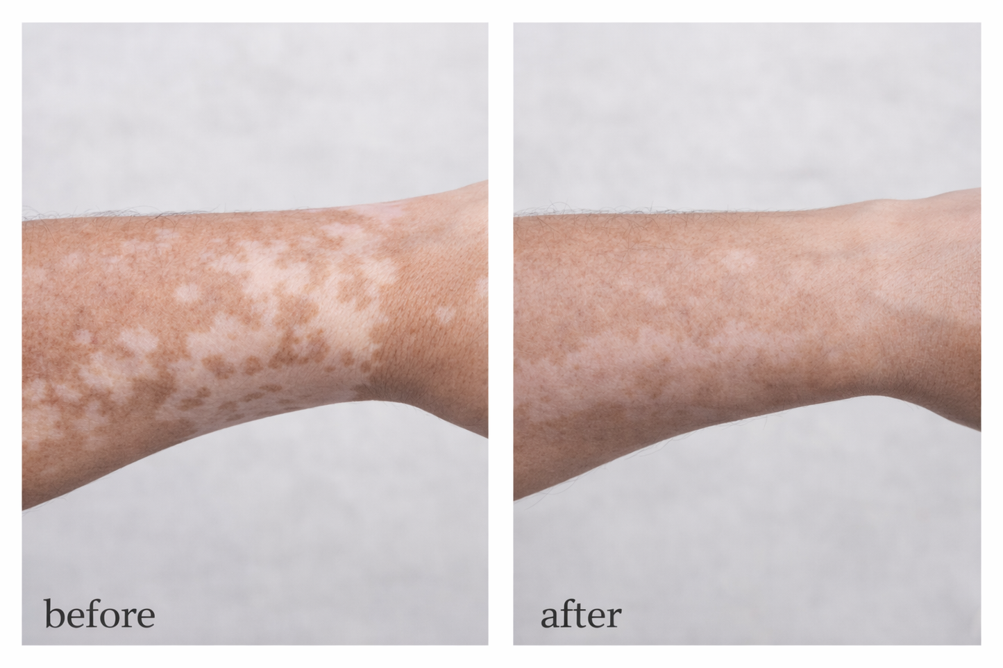Vitiligo Corrector | 1+1 FREE