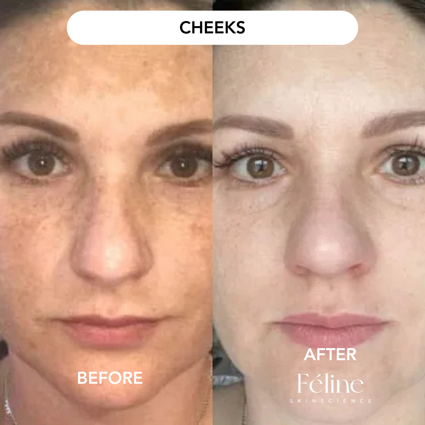 Melasma Corrector