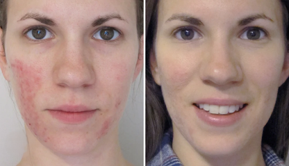 1 x Rosacea Corrector