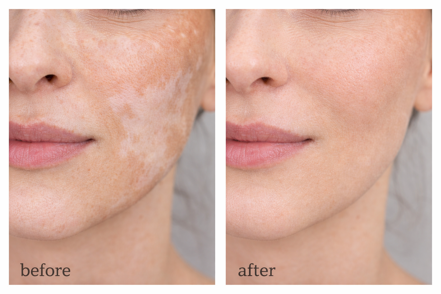 Vitiligo Corrector | 1+1 FREE