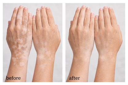 Vitiligo Corrector | 1+1 FREE