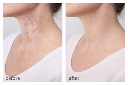 Vitiligo Corrector | 1+1 FREE