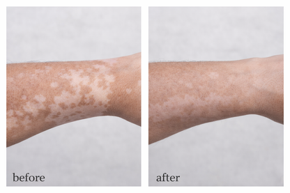 Vitiligo Corrector | 1+1 FREE