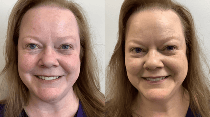 1 x Rosacea Corrector
